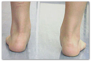 piede piatto valgo in paziente pediatrico piede piatto pediatrico