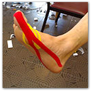 trattamento con taping neuromuscolare di alluce valgo taping su alluce valgo